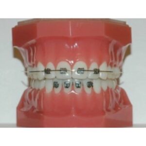 022 Mini Edgewise Vs Double Upper Lateral