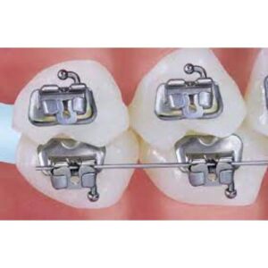 Halo Molar Band And Buccal Tube And Button